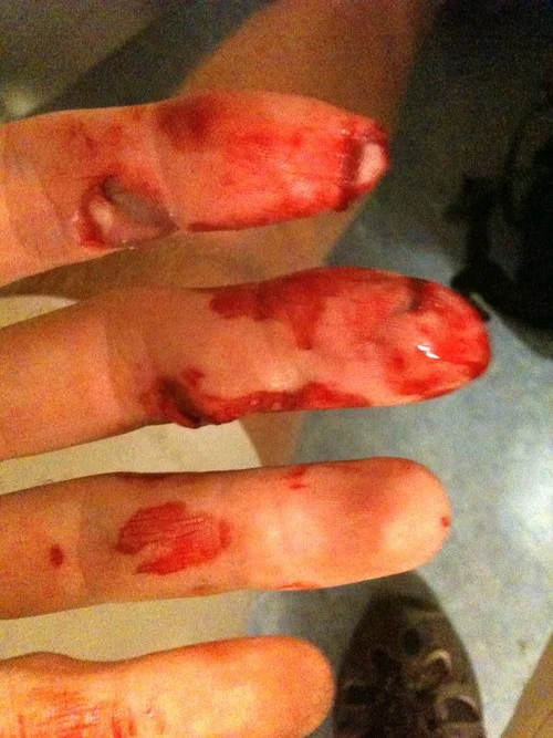 The injured fingers, bandaged at the hospital