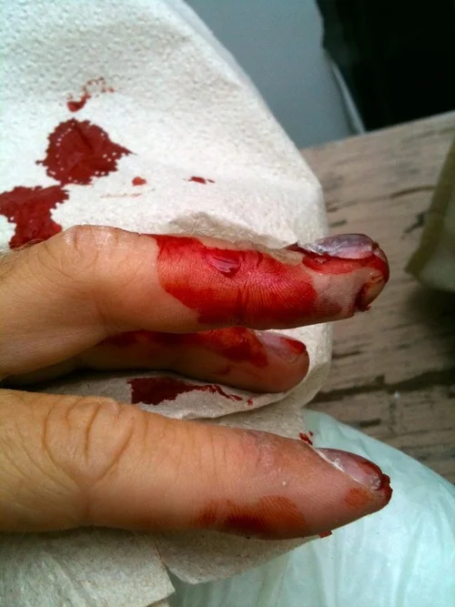 The crushed fingertips
