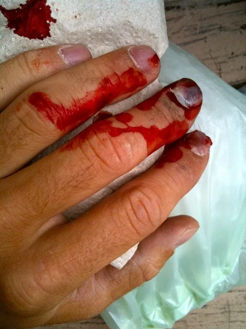 The hand during treatment